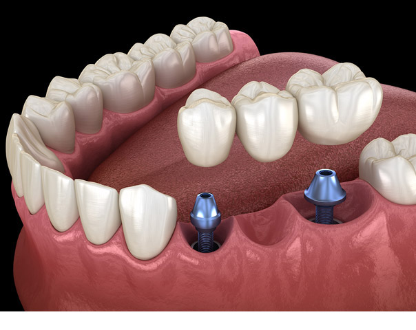 implant supported bridge dental at joondalup